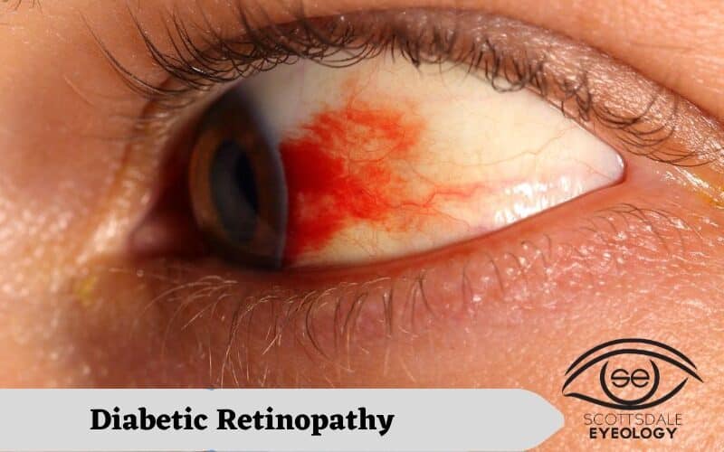 Diabetic-Retinopathy