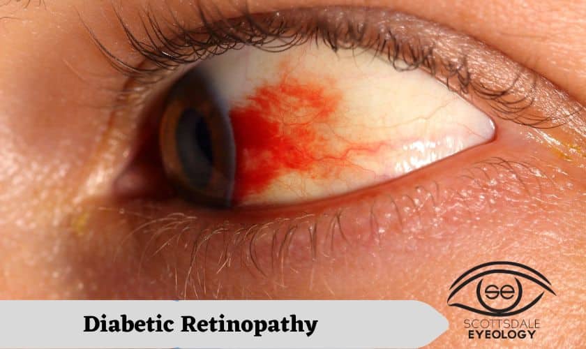 Diabetic-Retinopathy