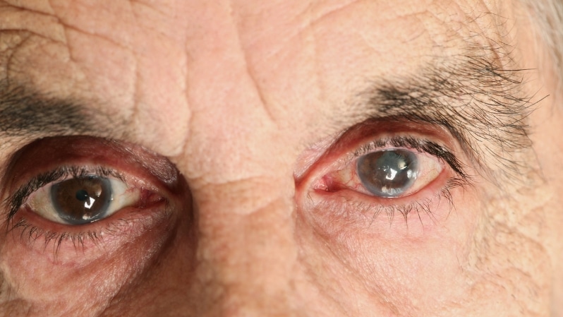 treatment options for secondary glaucoma